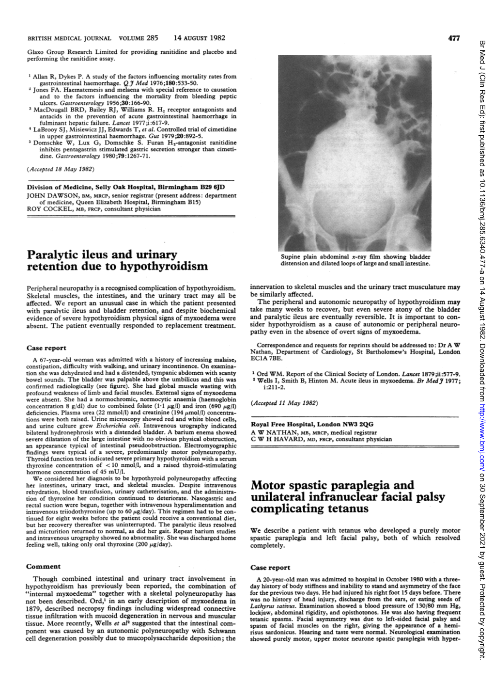 Paralytic Ileus and Urinary Retention Due to Hypothyroidism Motor Spastic