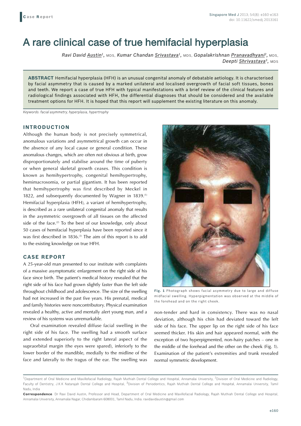 A Rare Clinical Case of True Hemifacial Hyperplasia