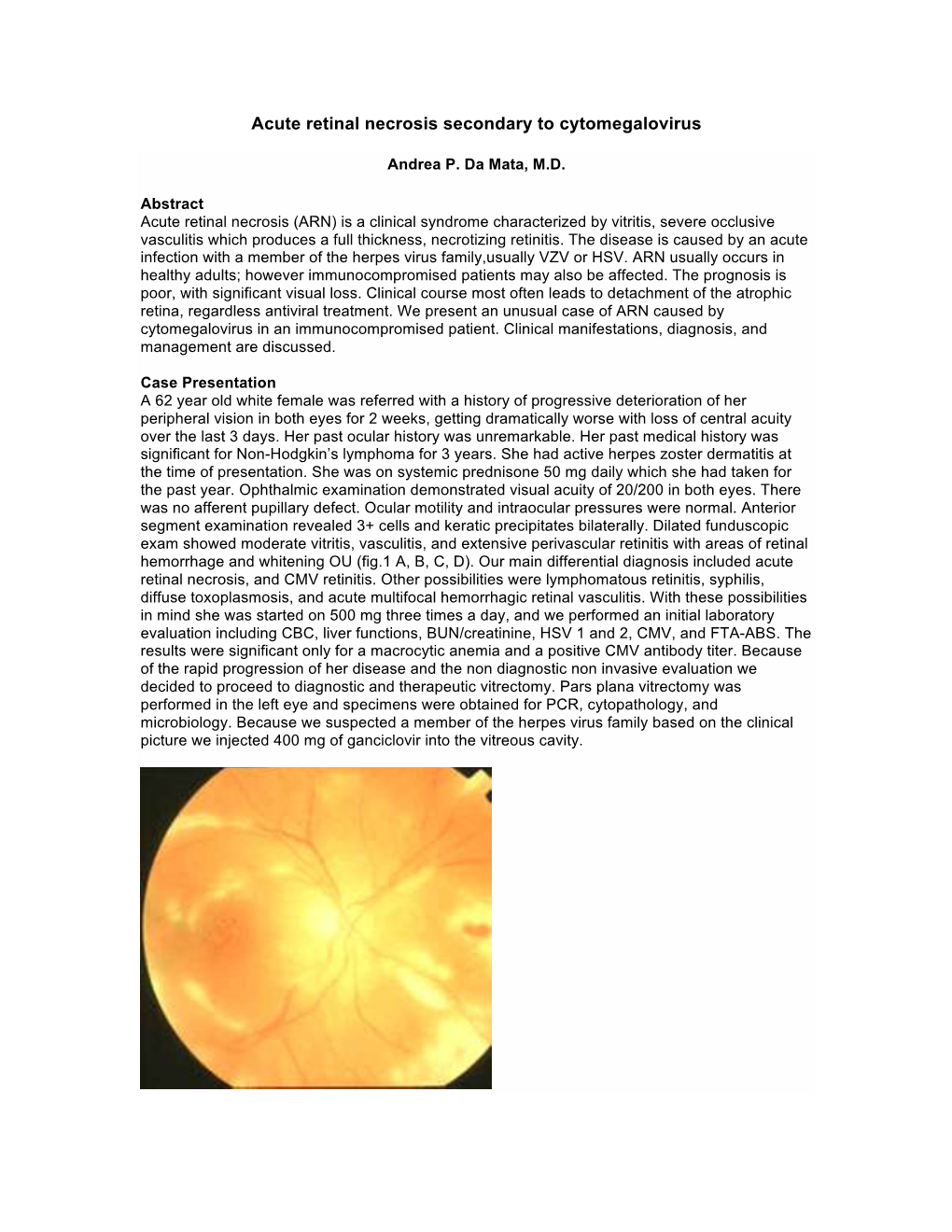 Acute Retinal Necrosis Secondary to Cytomegalovirus