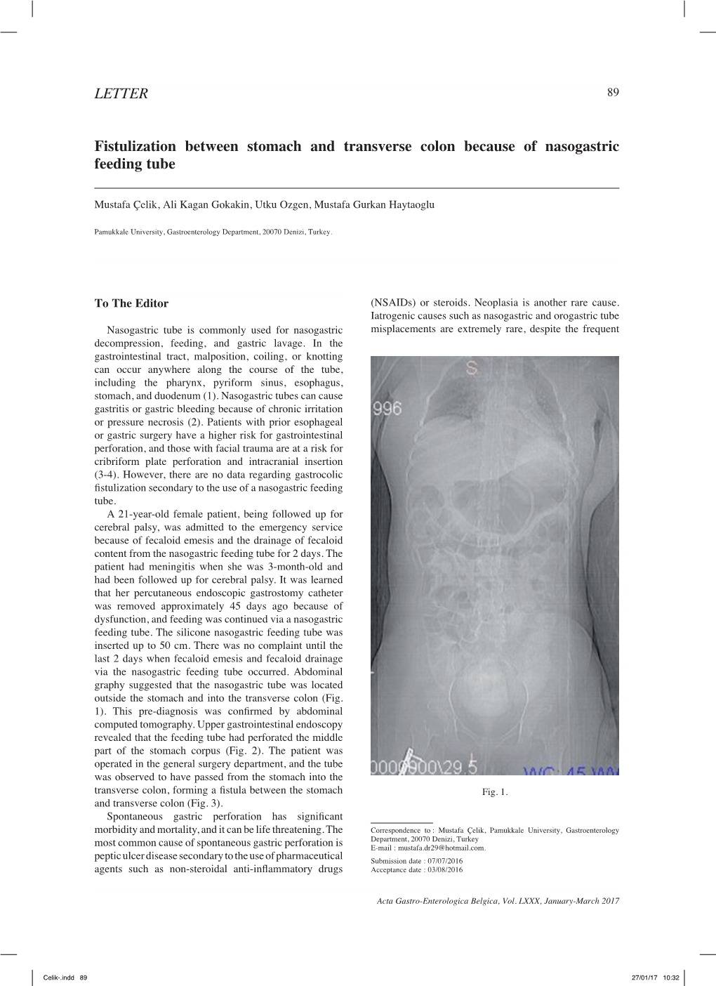 Fistulization Between Stomach and Transverse Colon Because of Nasogastric Feeding Tube