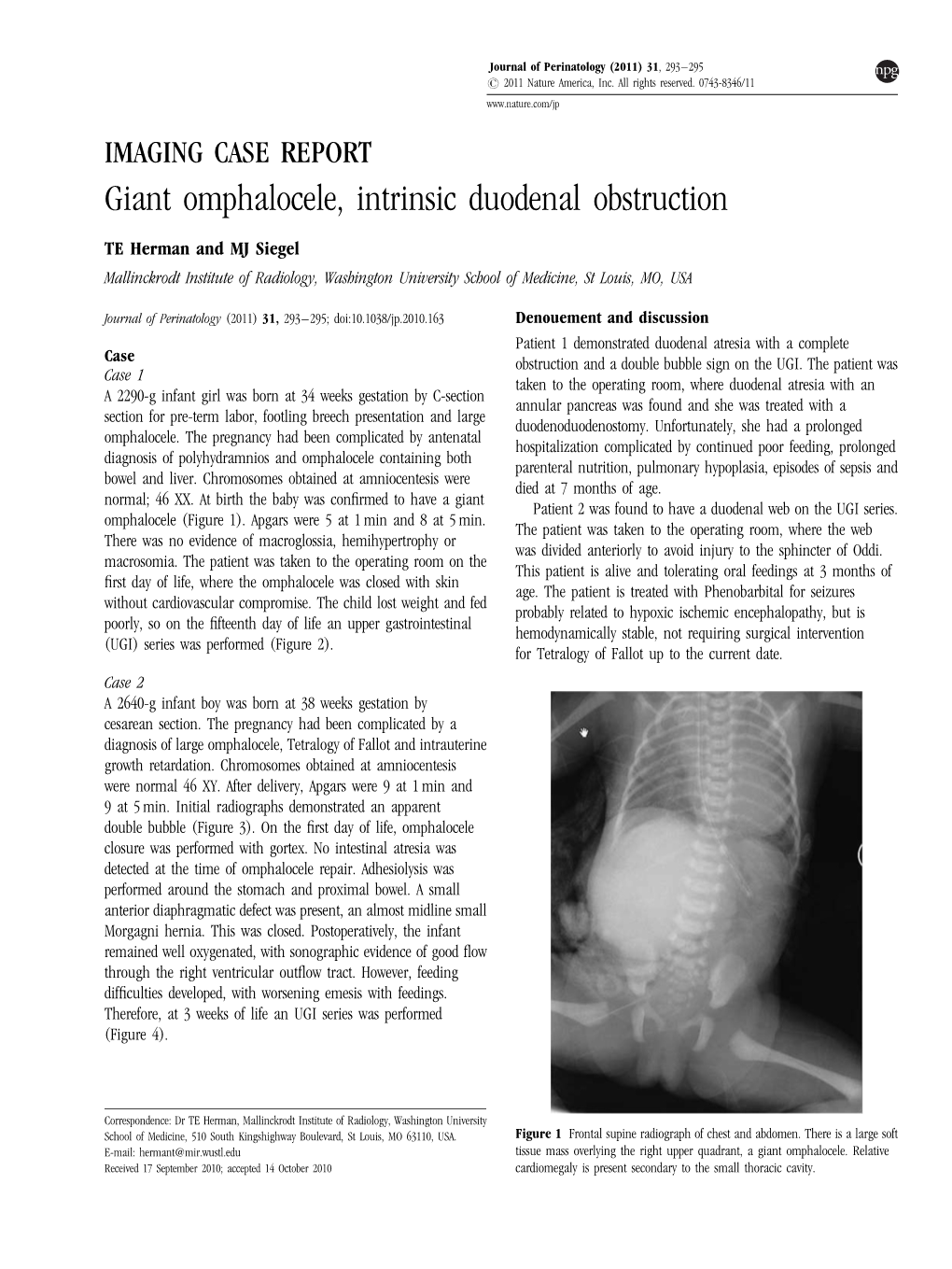 Giant Omphalocele, Intrinsic Duodenal Obstruction