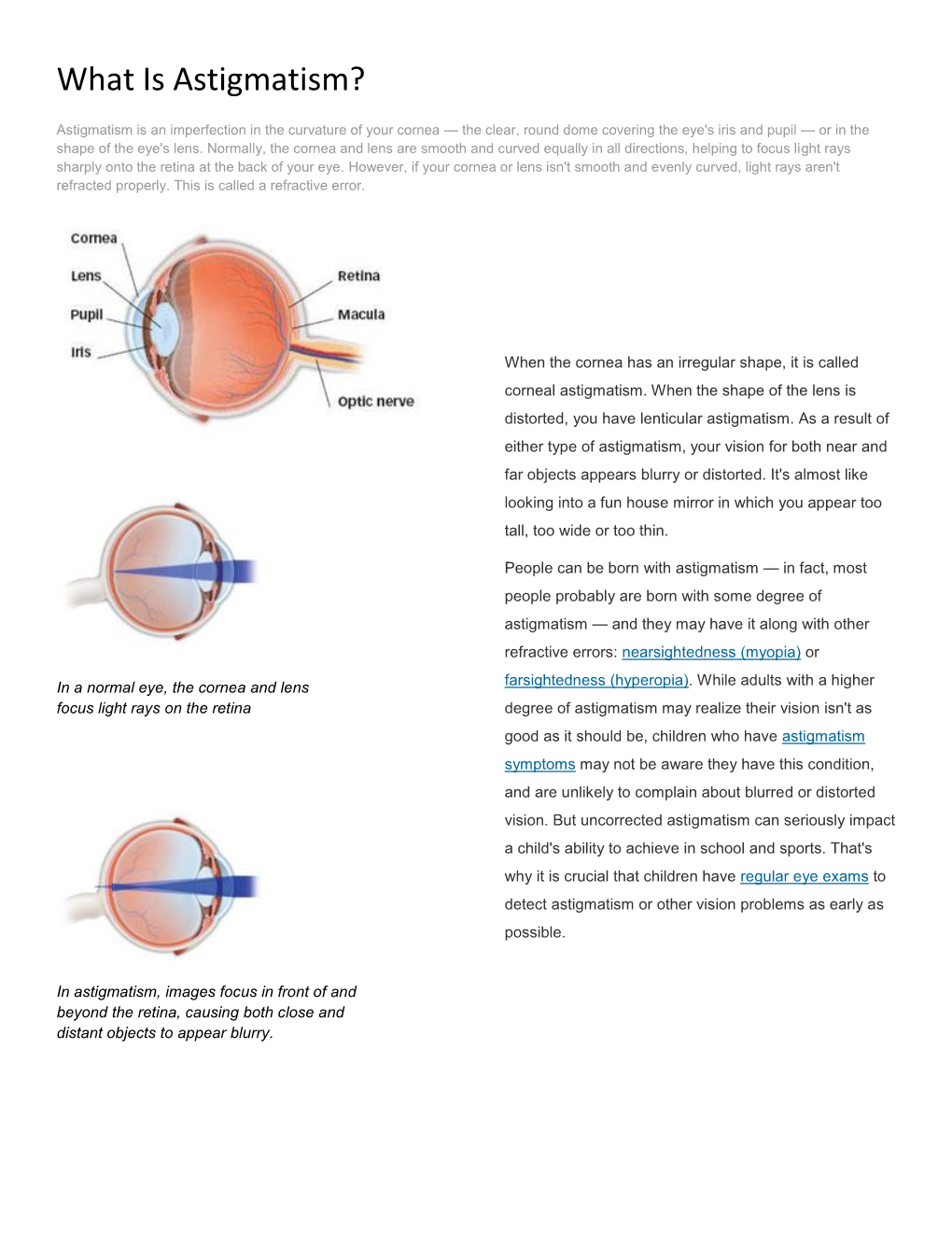 What Is Astigmatism.Pdf