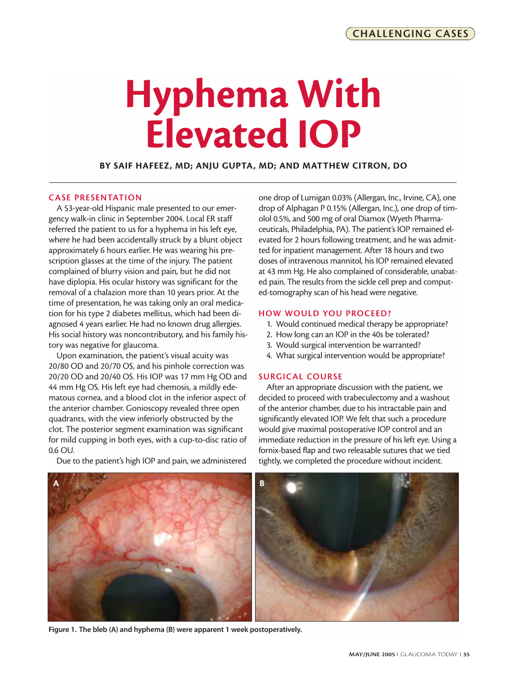 Hyphema with Elevated IOP by SAIF HAFEEZ, MD; ANJU GUPTA, MD; and MATTHEW CITRON, DO