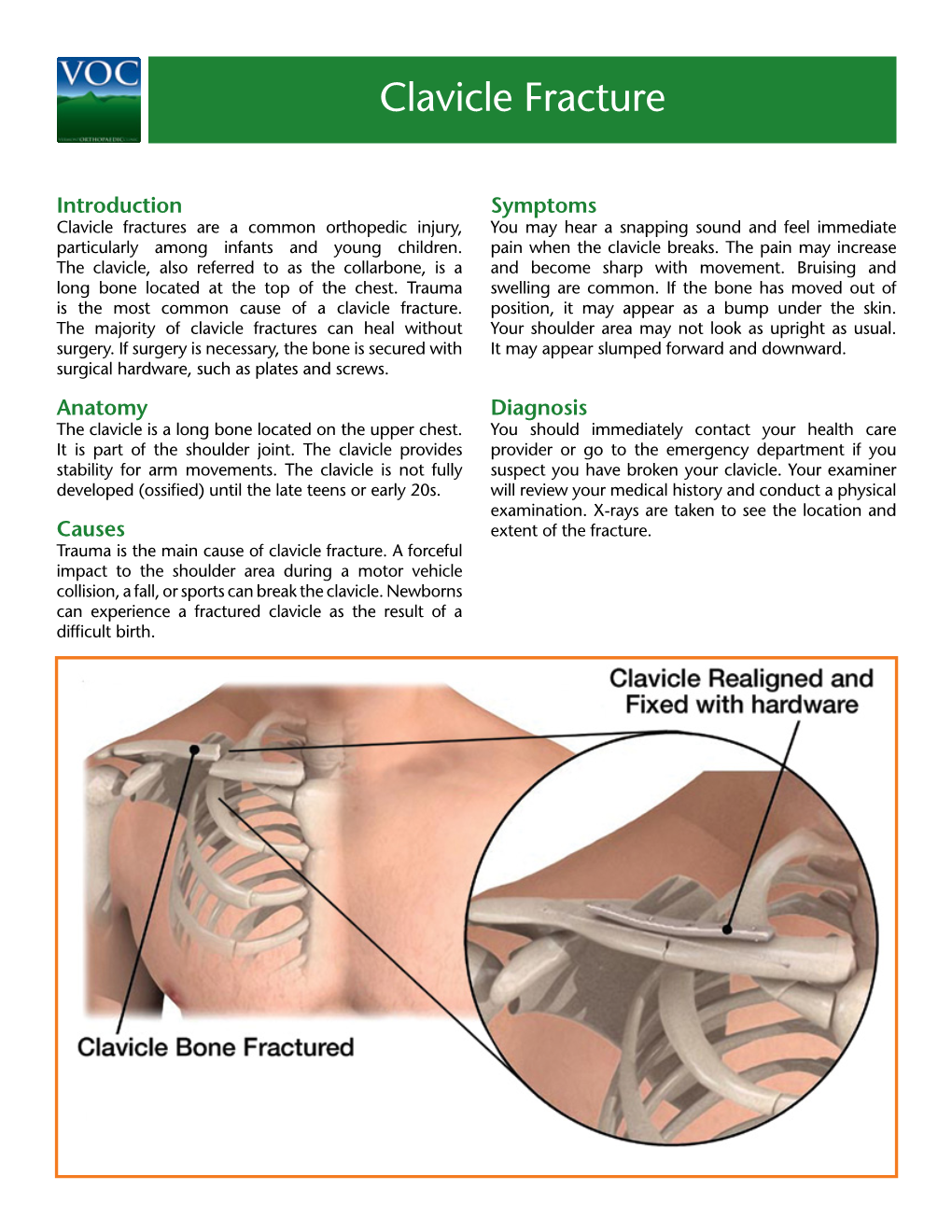 Clavicle Fracture