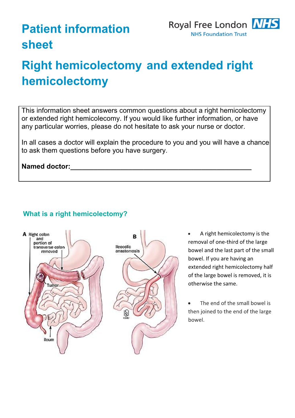 Right Hemicolectomy and Extended Right Hemicolectomy