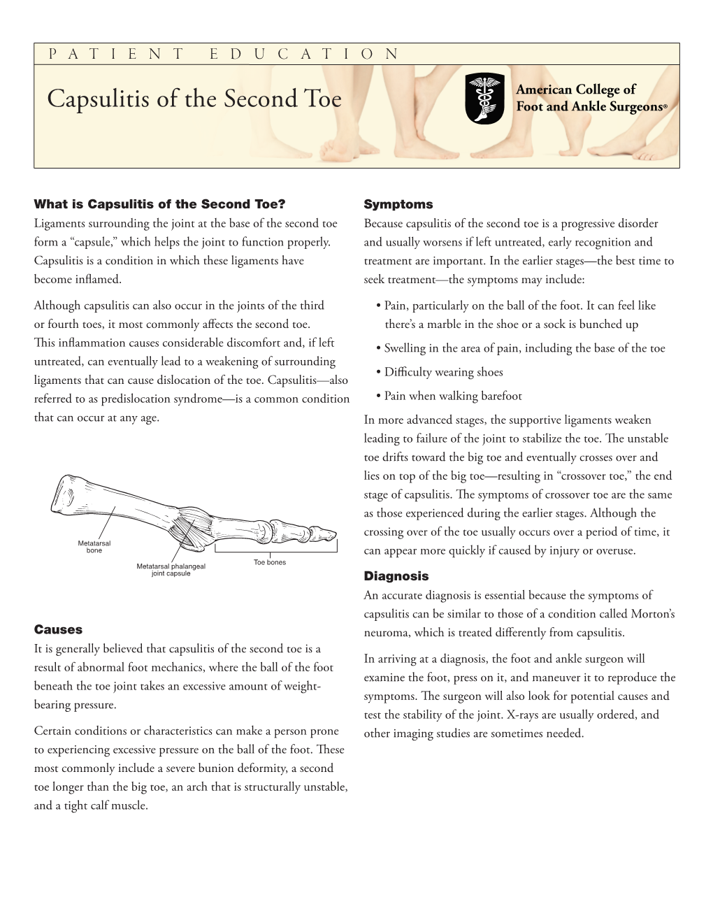 Capsulitis of the Second Toe