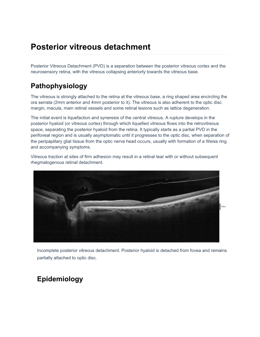 Posterior Vitreous Detachment