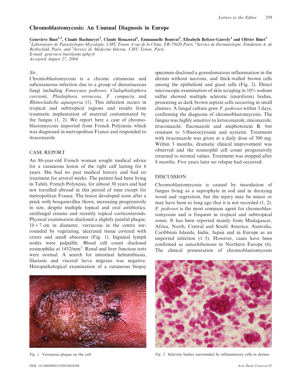 Chromoblastomycosis: an Unusual Diagnosis in Europe