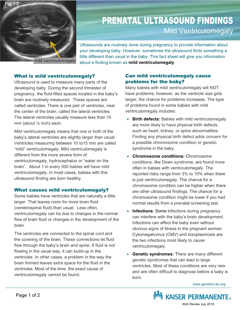 Prenatal Ultrasound Findings: Mild Ventriculomegaly