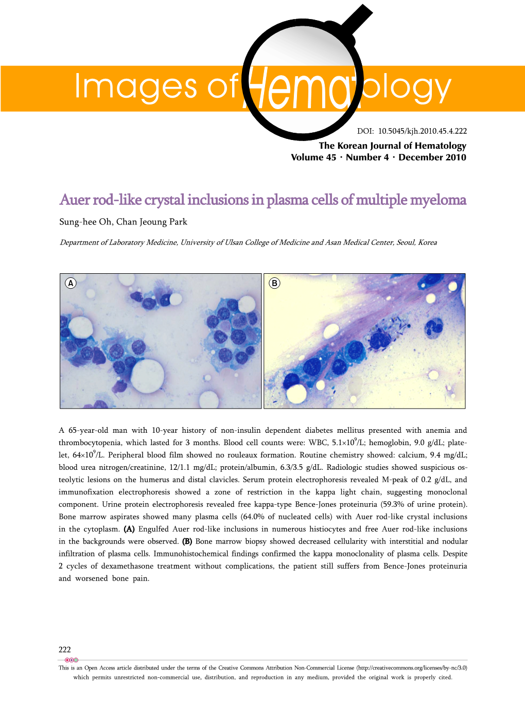 Auer Rod-Like Crystal Inclusions in Plasma Cells of Multiple Myeloma Sung-Hee Oh, Chan Jeoung Park