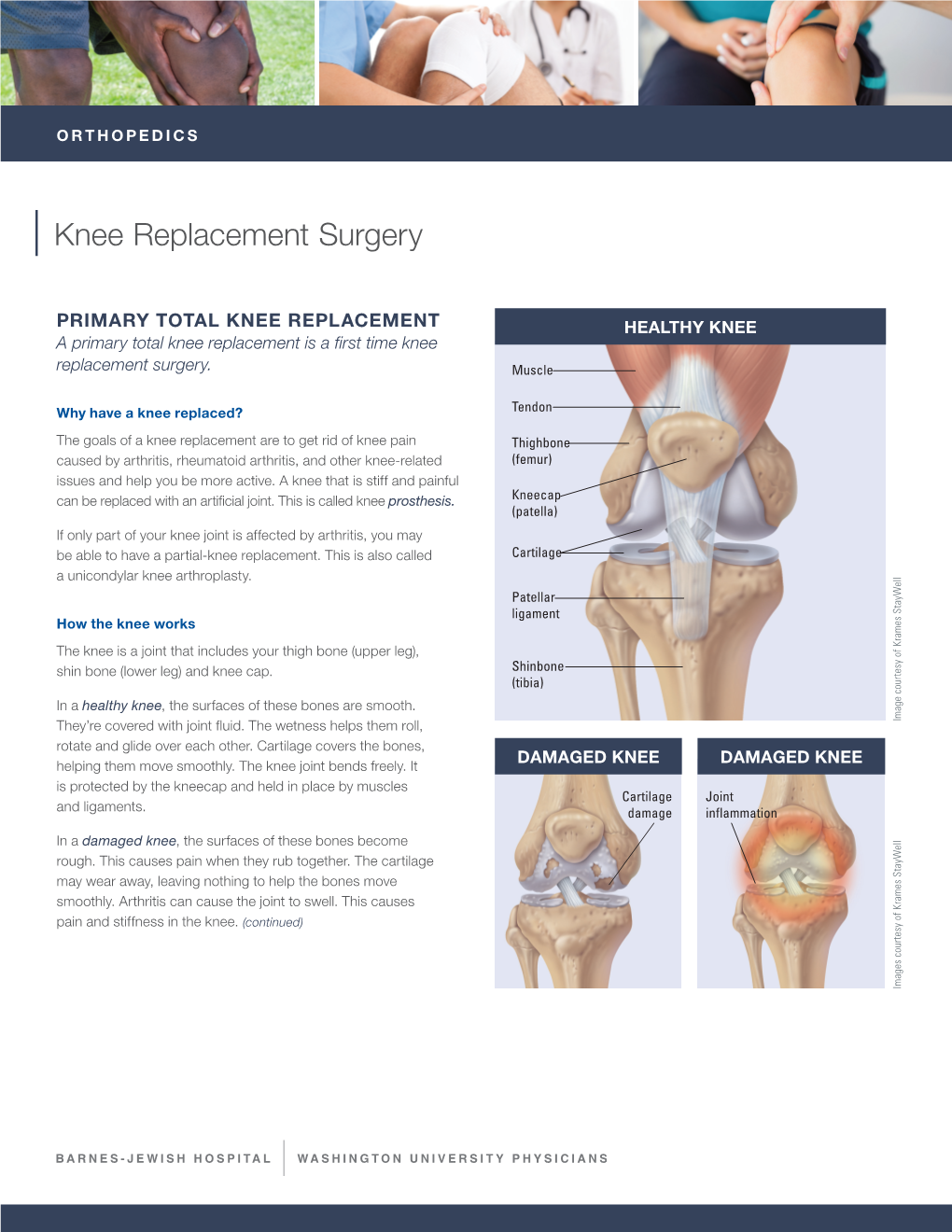 BJH24902 Knee Replacement