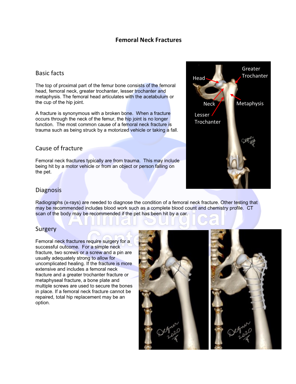 Femoral Neck Fractures Basic Facts Cause of Fracture Diagnosis Surgery