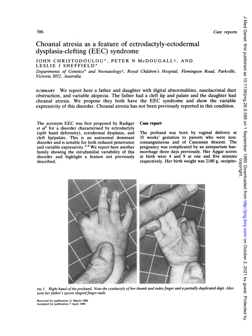 Choanal Atresia As a Feature of Ectrodactyly-Ectodermal Dysplasia