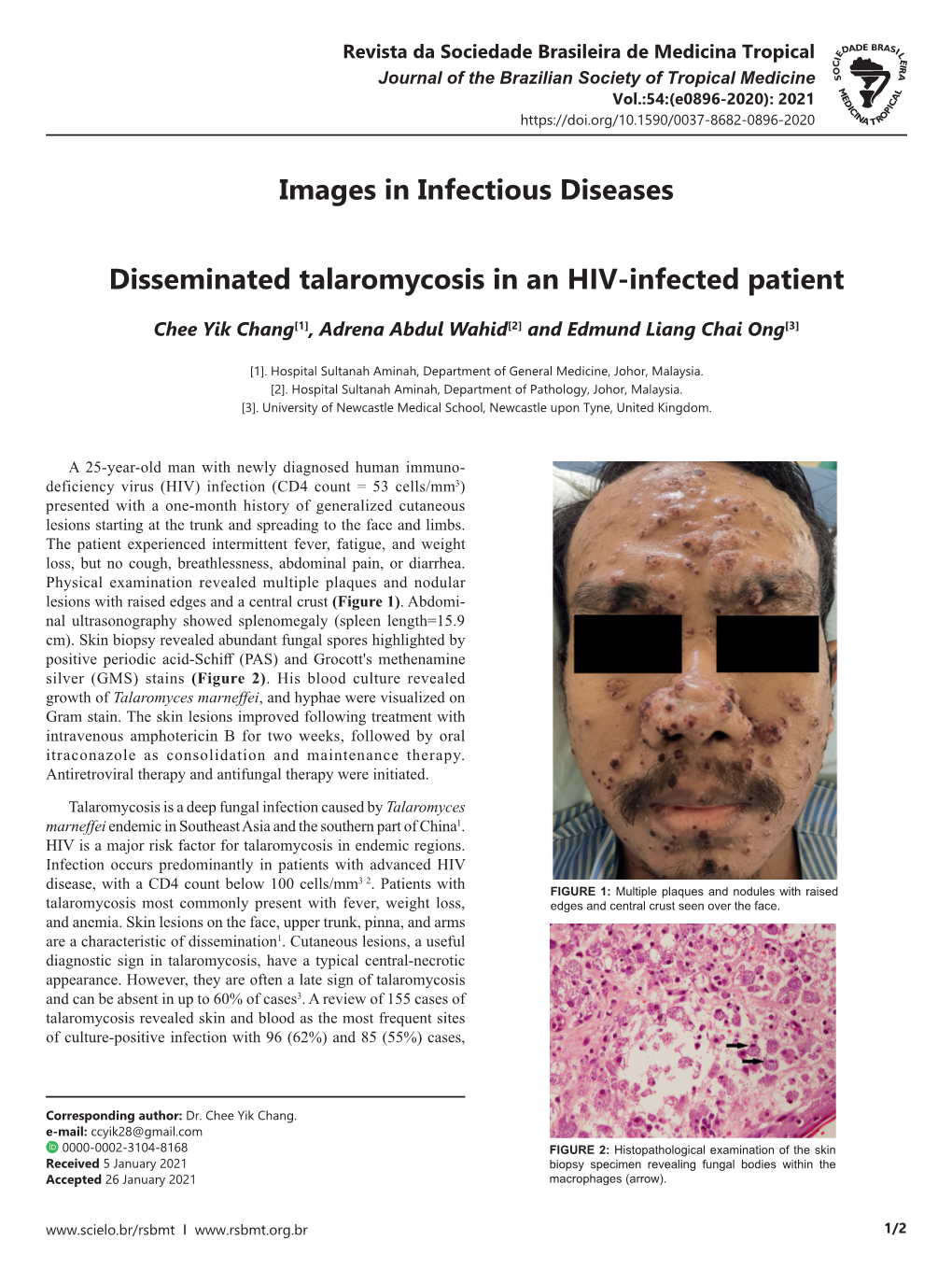 Images in Infectious Diseases Disseminated Talaromycosis in An
