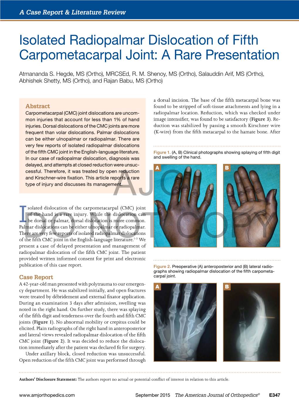 Isolated Radiopalmar Dislocation of Fifth Carpometacarpal Joint: a Rare Presentation