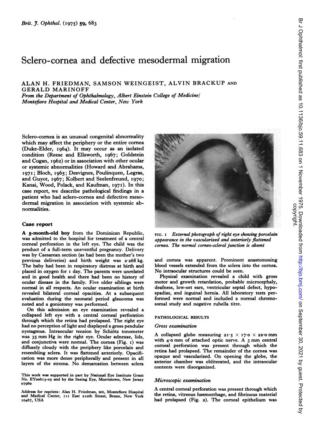 Sclero-Cornea and Defective Mesodermal Migration