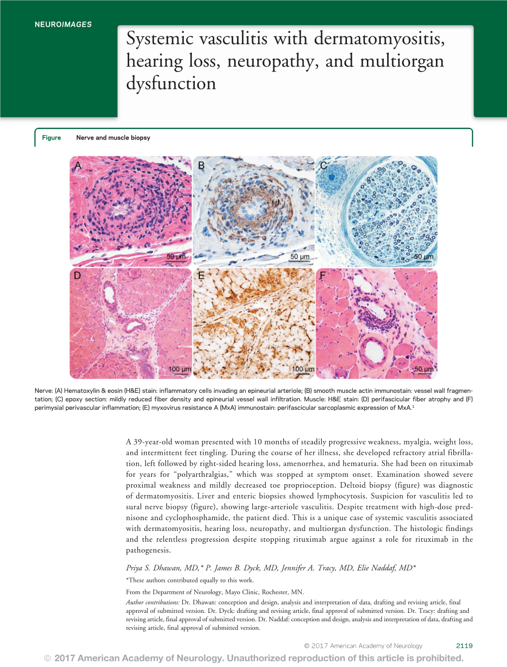 Systemic Vasculitis with Dermatomyositis, Hearing Loss, Neuropathy, and Multiorgan Dysfunction