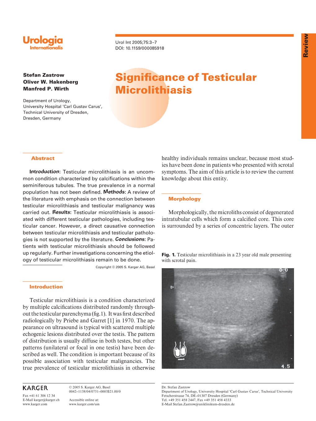 Significance of Testicular Microlithiasis