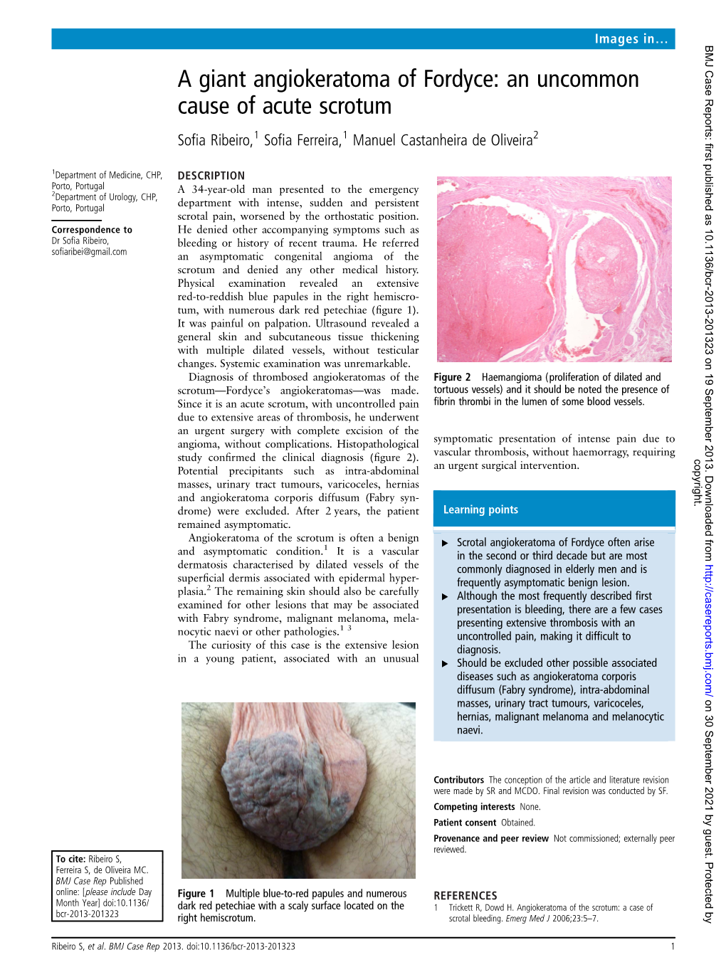 A Giant Angiokeratoma of Fordyce: an Uncommon Cause of Acute Scrotum Soﬁa Ribeiro,1 Soﬁa Ferreira,1 Manuel Castanheira De Oliveira2