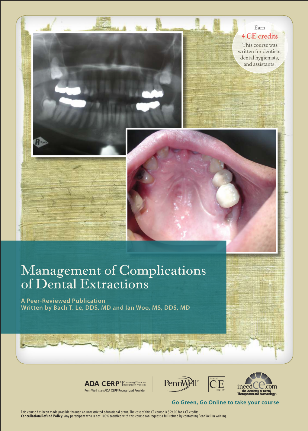 Management of Complications of Dental Extractions a Peer-Reviewed Publication Written by Bach T
