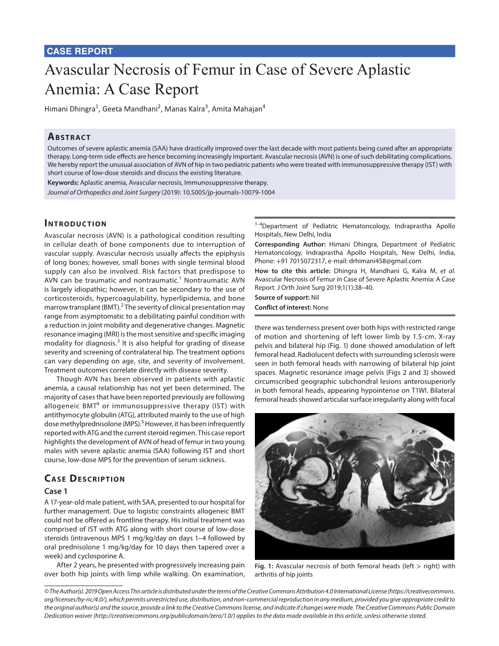 Avascular Necrosis of Femur in Case of Severe Aplastic Anemia: a Case Report Himani Dhingra1, Geeta Mandhani2, Manas Kalra3, Amita Mahajan4