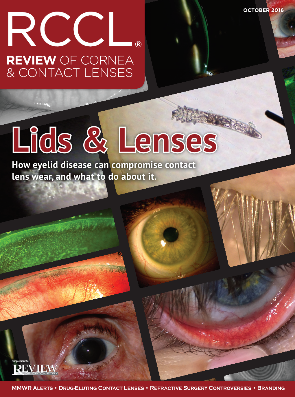 Review of Cornea & Contact Lenses