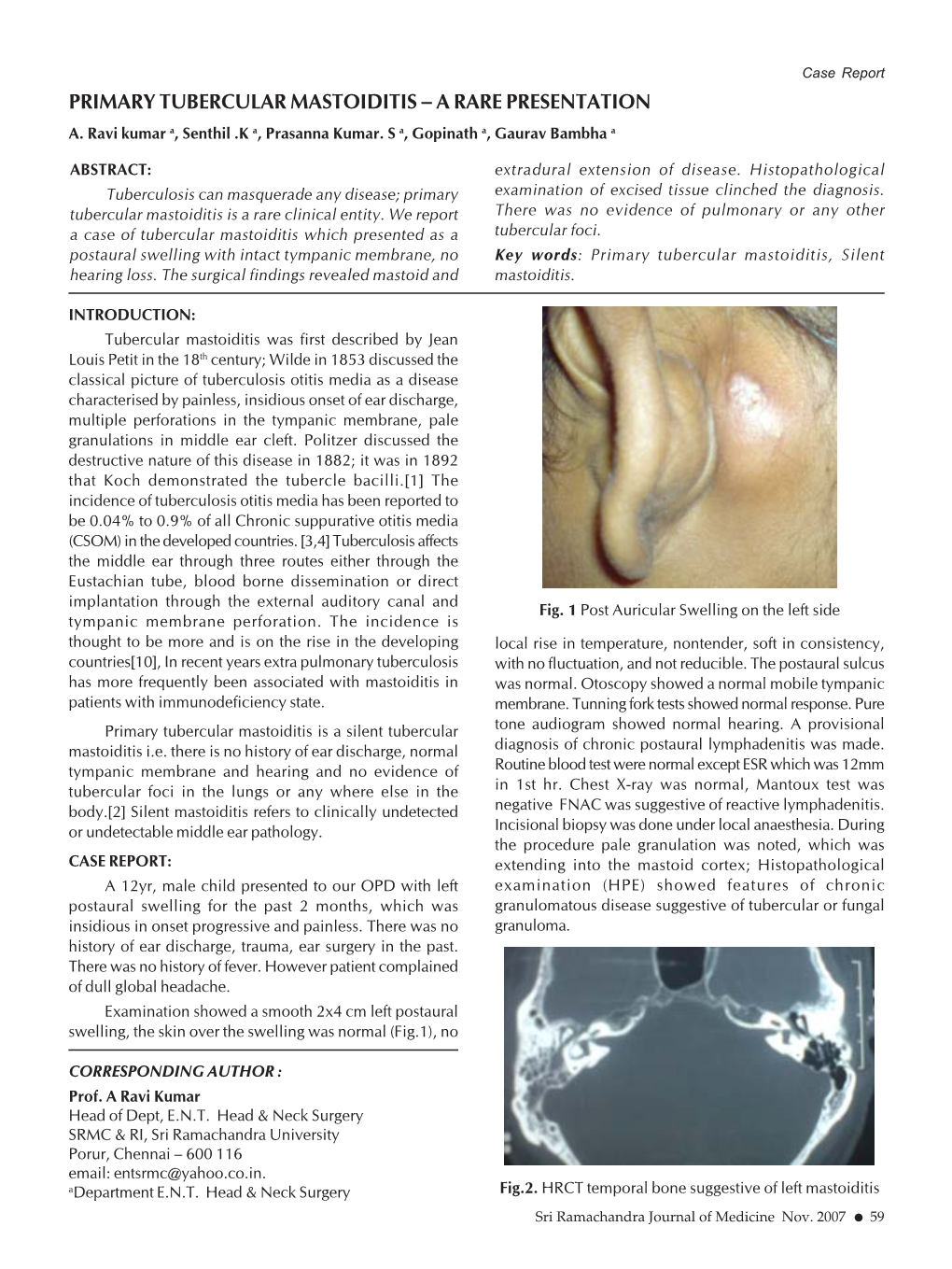 Primary Tubercular Mastoiditis – a Rare Presentation A