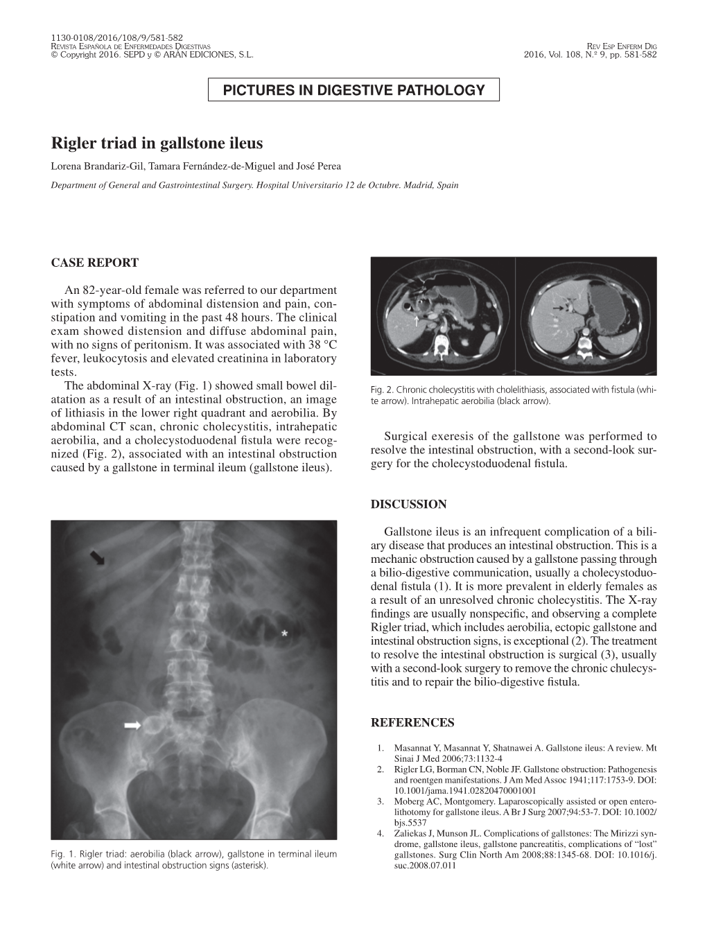 Rigler Triad in Gallstone Ileus Lorena Brandariz-Gil, Tamara Fernández-De-Miguel and José Perea Department of General and Gastrointestinal Surgery