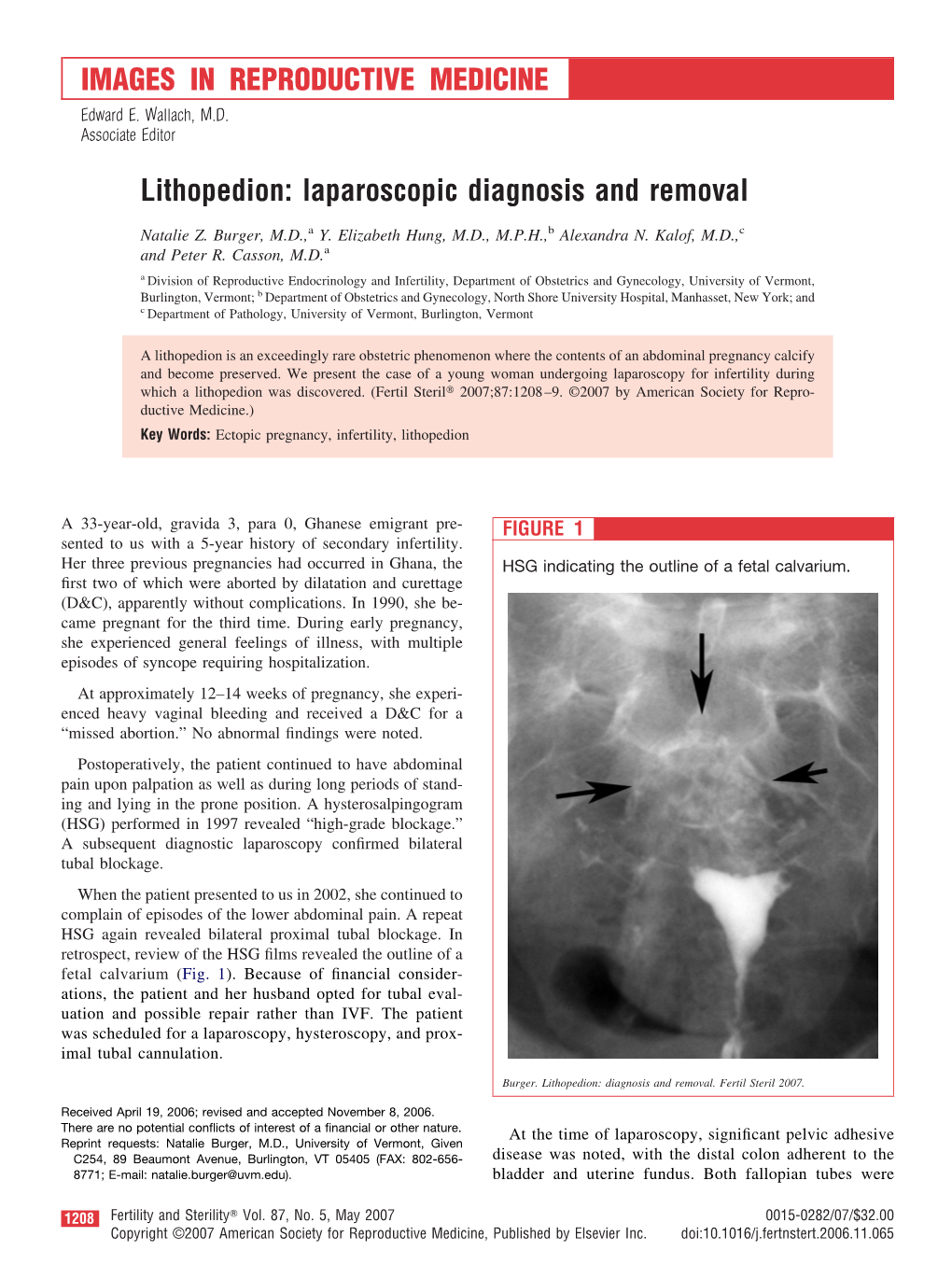 Lithopedion: Laparoscopic Diagnosis and Removal IMAGES IN