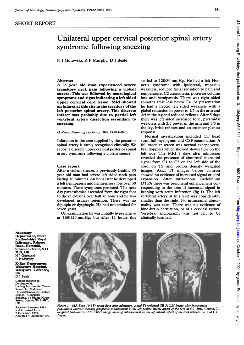 Unilateral Upper Cervical Posterior Spinal Artery Syndrome Following Sneezing