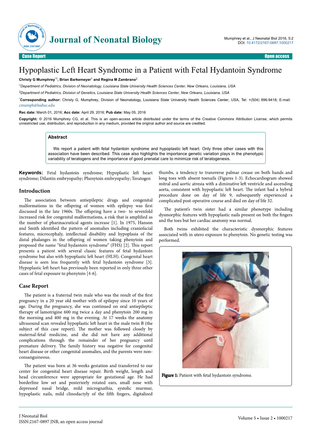 Hypoplastic Left Heart Syndrome in a Patient with Fetal Hydantoin Syndrome