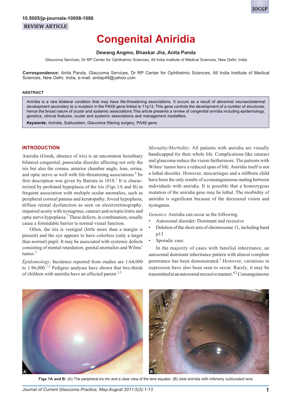 Congenital Aniridia Congenital Aniridia