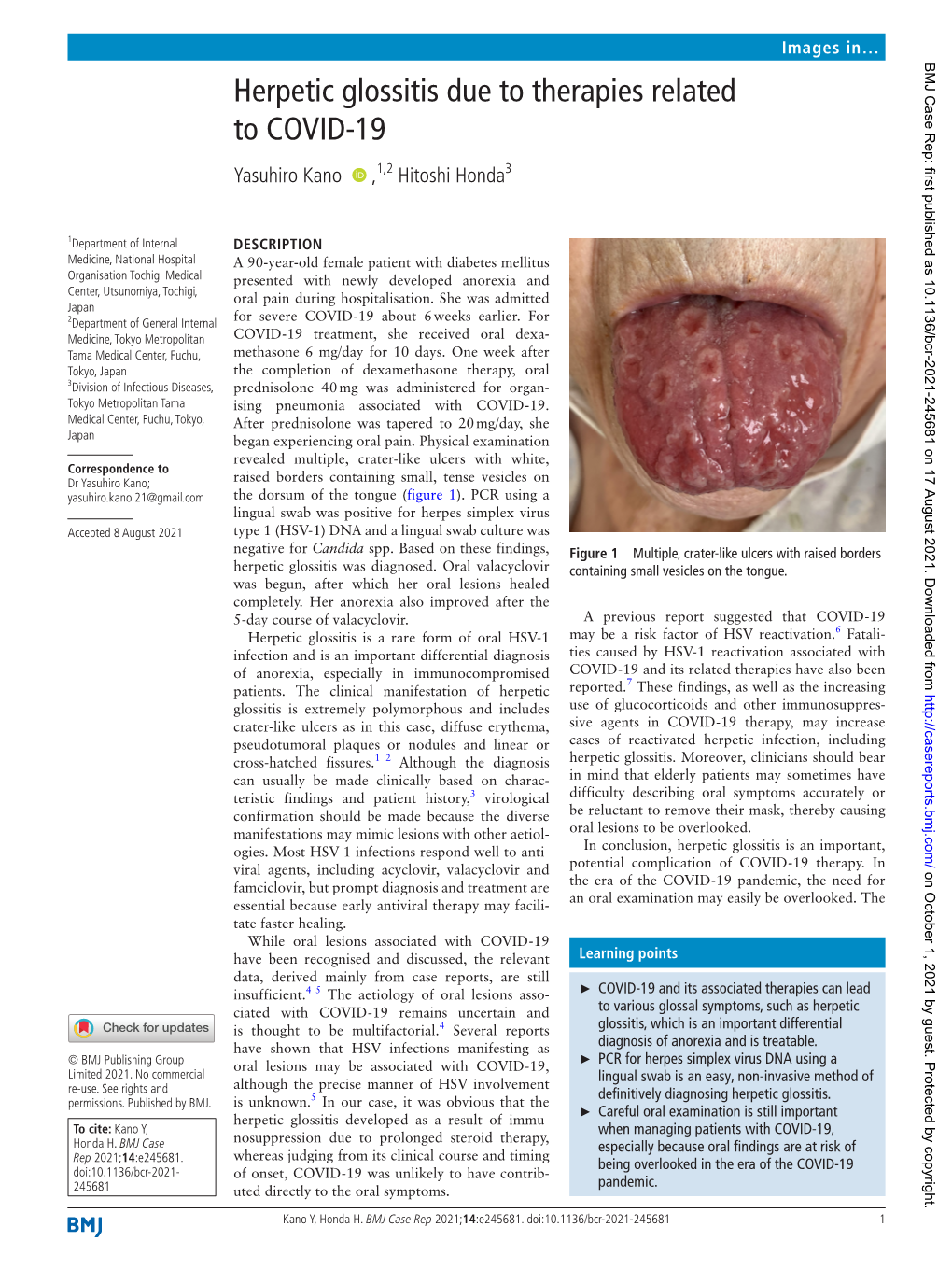 Herpetic Glossitis Due to Therapies Related to COVID-19 Yasuhiro Kano ‍ ‍ ,1,2 Hitoshi Honda3