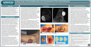 A Rare Case of Dermatofibrosarcoma Protuberans in the Lower