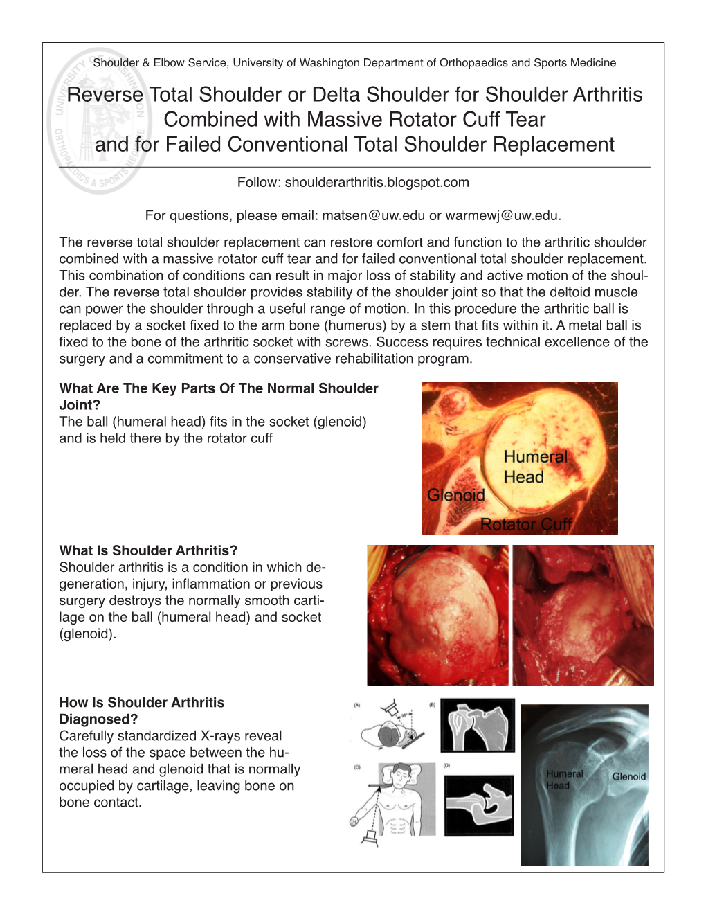 Reverse Total Shoulder Or Delta Shoulder for Shoulder Arthritis Combined with Massive Rotator Cuff Tear and for Failed Conventional Total Shoulder Replacement