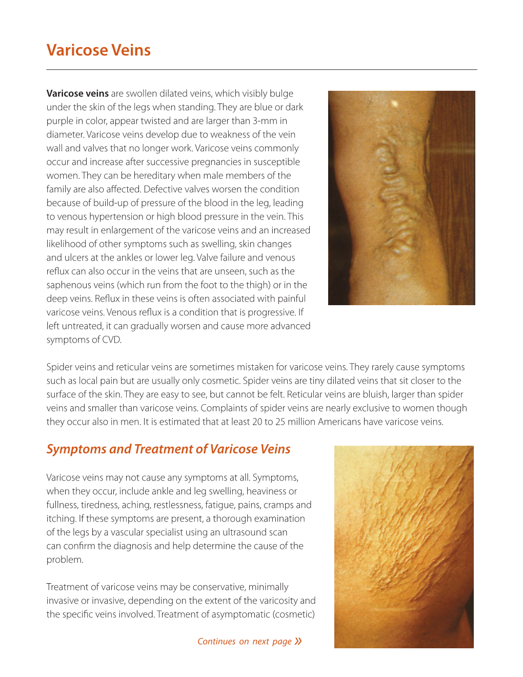 Varicose Veins