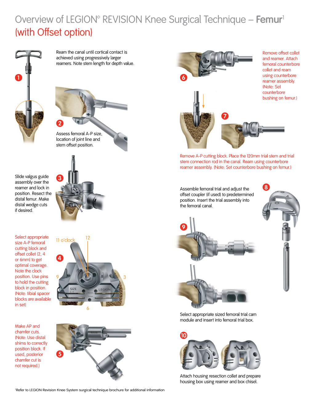 Overview of LEGION™ REVISION Knee Surgical Technique – Femur1 (With Offset Option)