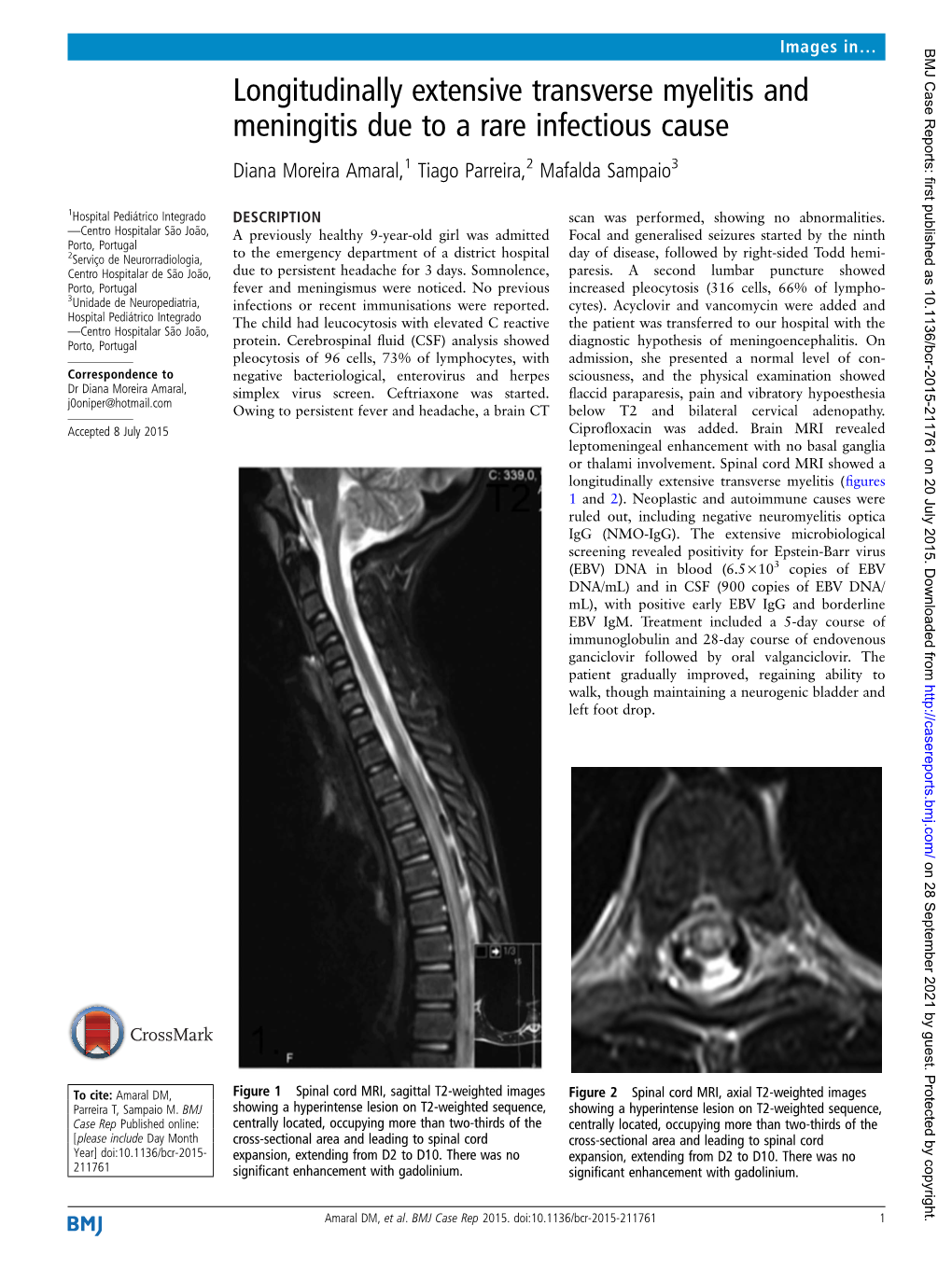 Longitudinally Extensive Transverse Myelitis and Meningitis Due to a Rare Infectious Cause Diana Moreira Amaral,1 Tiago Parreira,2 Mafalda Sampaio3