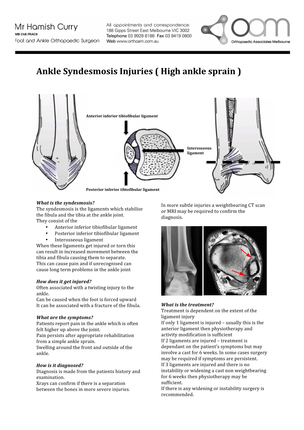 Ankle Syndesmosis Injuries High Ankle Sprain Docslib 5923