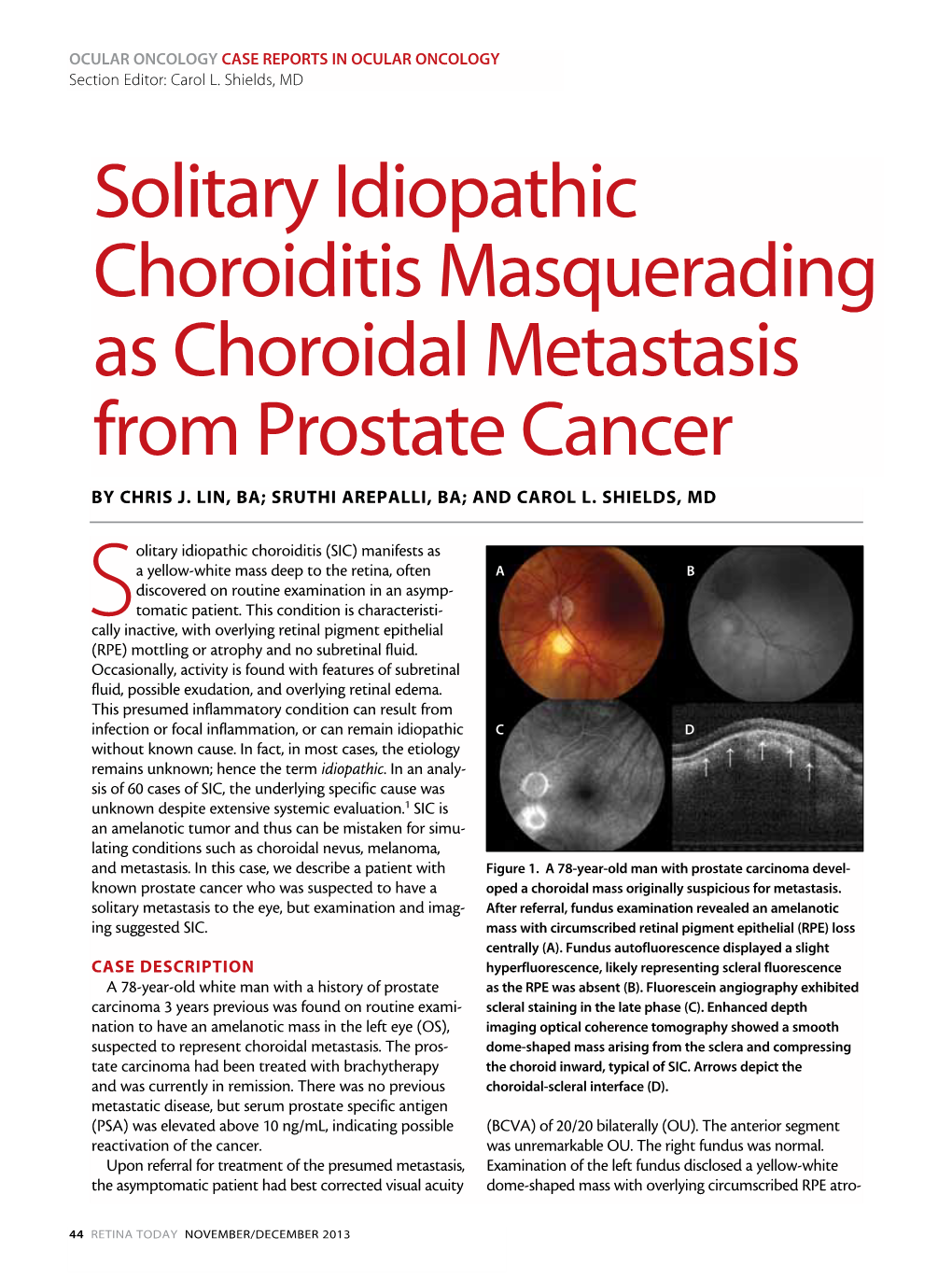 Solitary Idiopathic Choroiditis Masquerading As Choroidal Metastasis from Prostate Cancer by Chris J