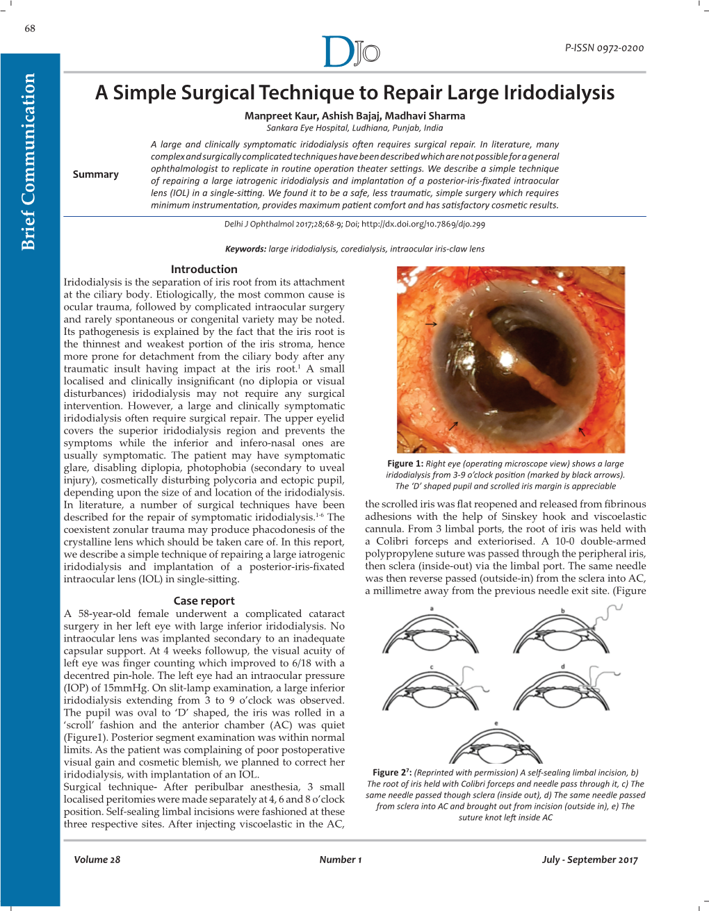 A Simple Surgical Technique to Repair Large Iridodialysis