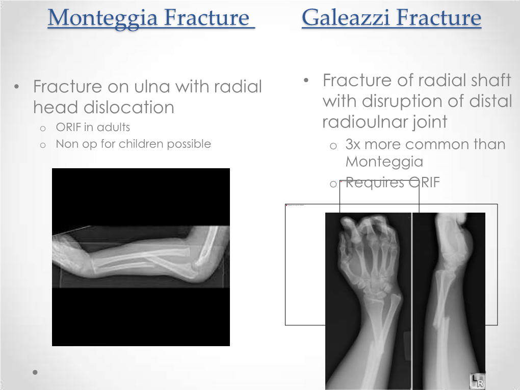 Monteggia Fracture Galeazzi Fracture