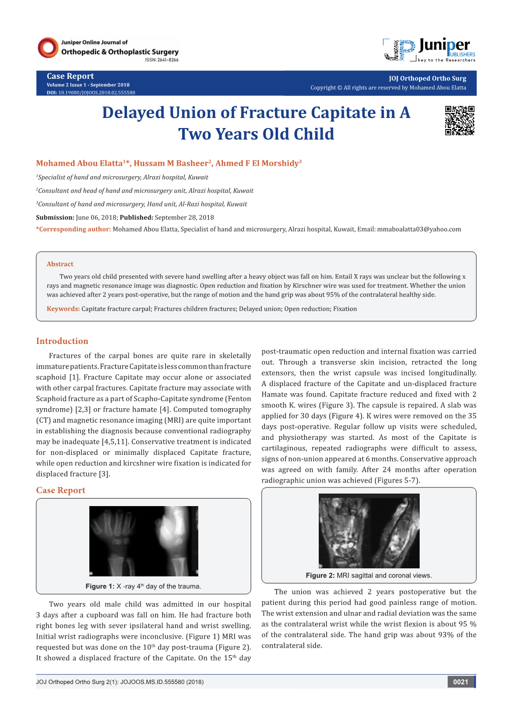 Delayed Union of Fracture Capitate in a Two Years Old Child