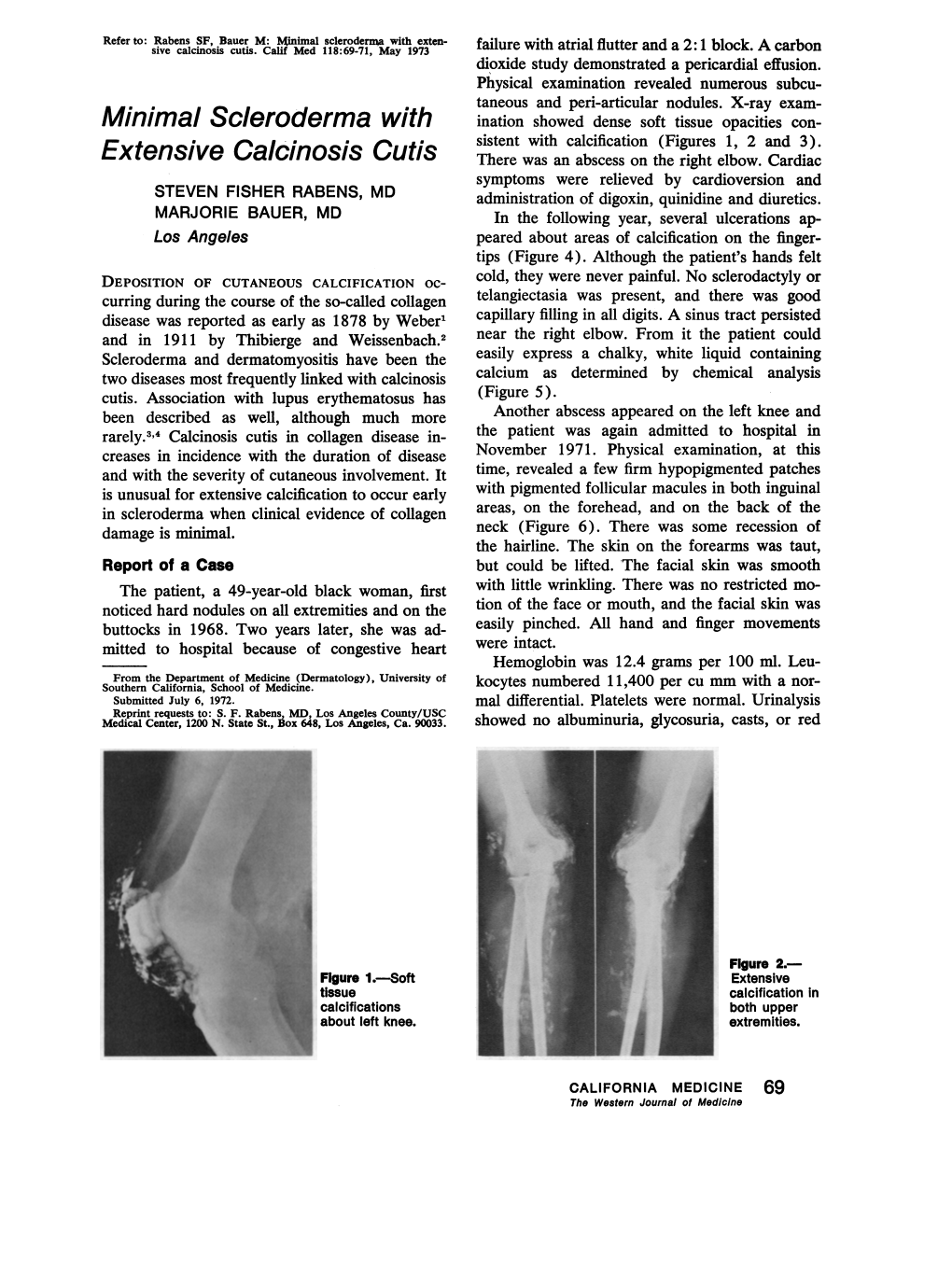 Minimal Scleroderma with Extensive Calcinosis Cutis