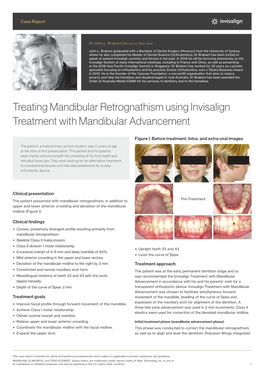 Treating Mandibular Retrognathism Using Invisalign Treatment with Mandibular Advancement
