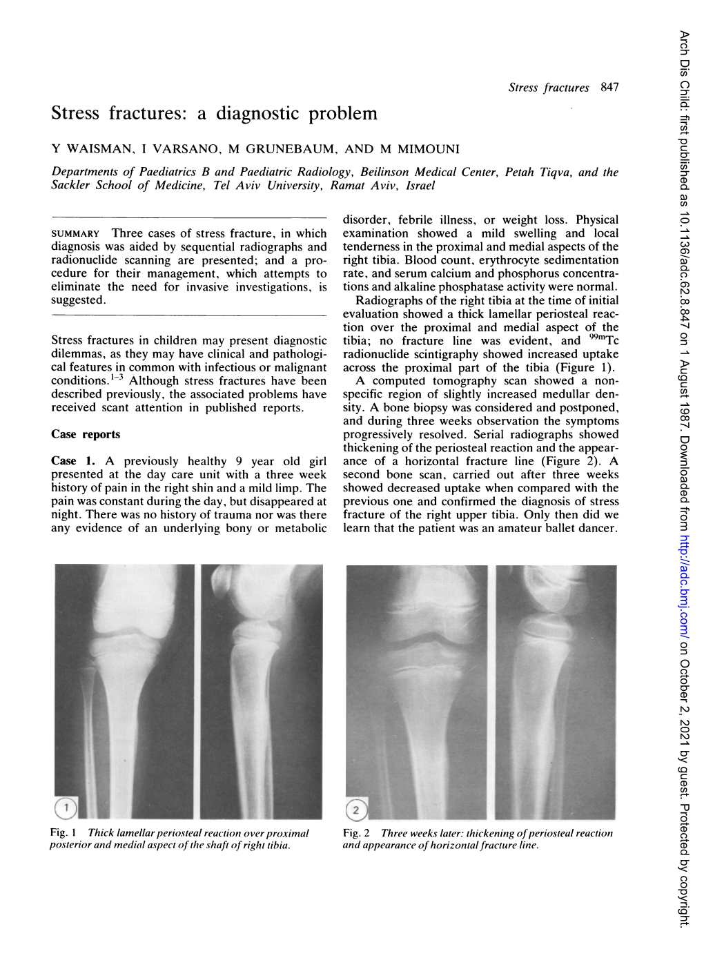 Stress Fractures: a Diagnostic Problem