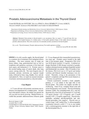Prostatic Adenocarcinoma Metastasis in the Thyroid Gland