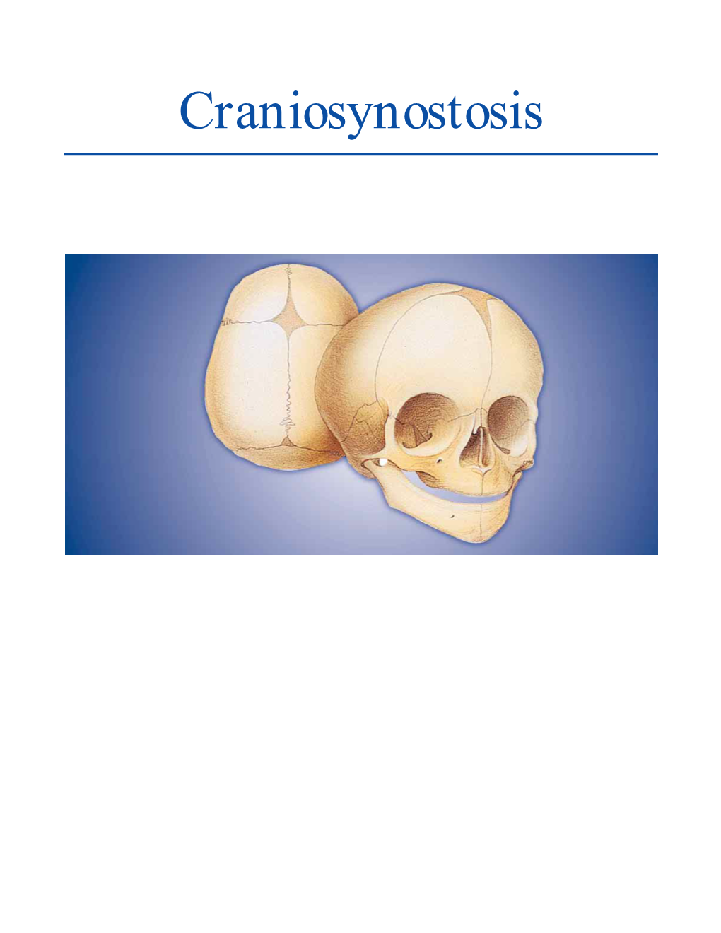 Craniosynostosis CRANIOSYNOSTOSIS