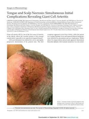 Tongue and Scalp Necrosis: Simultaneous Initial Complications Revealing Giant Cell Arteritis