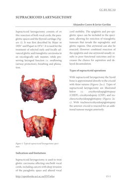 Supracricoid Laryngectomy for Laryngeal Cancer